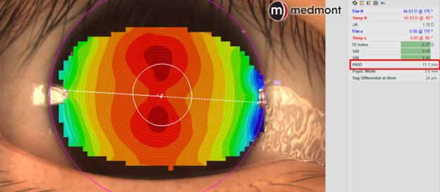 HVID measurements on the Medmont Meridia Pro advanced topographer