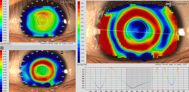 Left eye topography on the Medmont Meridia Pro advanced topographer