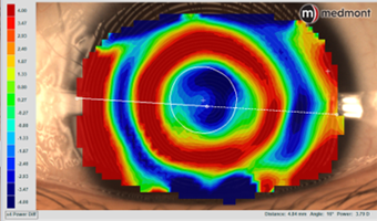 Achieving Myopia Management Success with Medmont Meridia™ Pro and Euclid MAX™ Toric