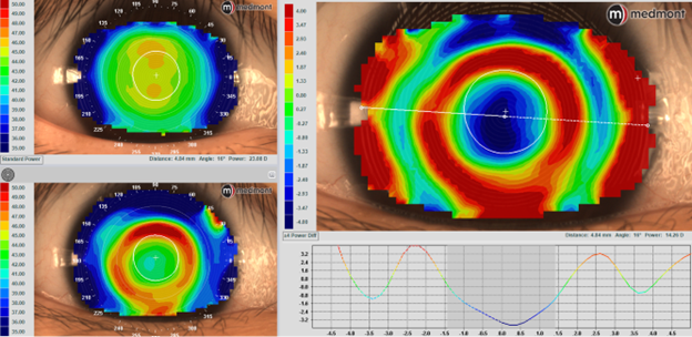 Right eye topography on the Medmont Meridia Pro advanced topographer