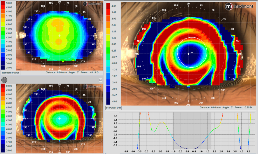 subtractive maps on the Medmont Meridia Pro advanced topographer