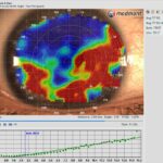 Tear Film Analysis