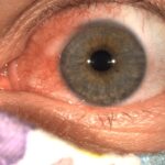 Conjunctival Lesions